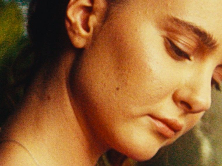 Cheek with a spot, before Skin Heal